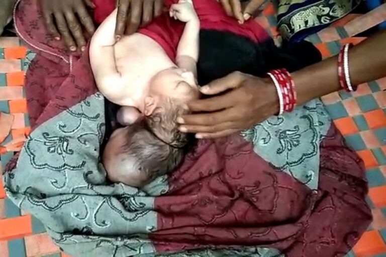 Lind në Indi një foshnje me tre koka, njerëzit atje e shohin si mishërimi i Zotit!