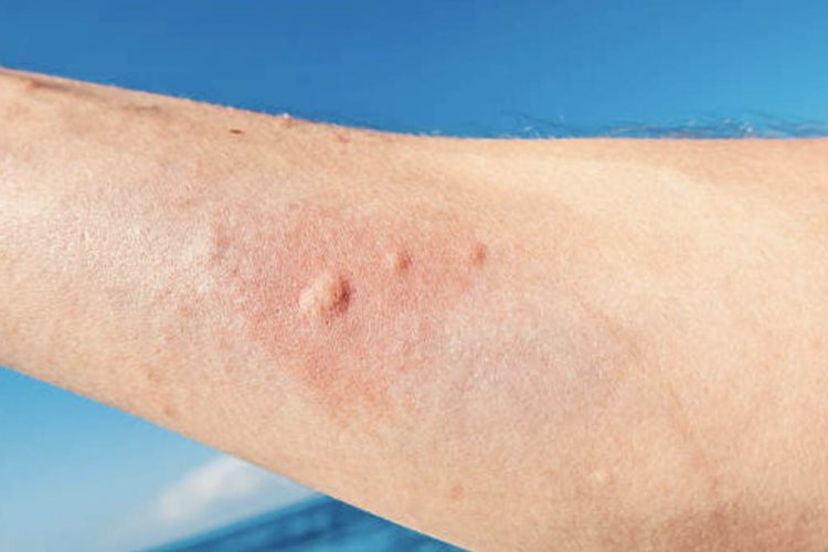 Koha e plazhit/ Njihuni me zgjidhjet më të shpejta kur ju djeg kandili i detit